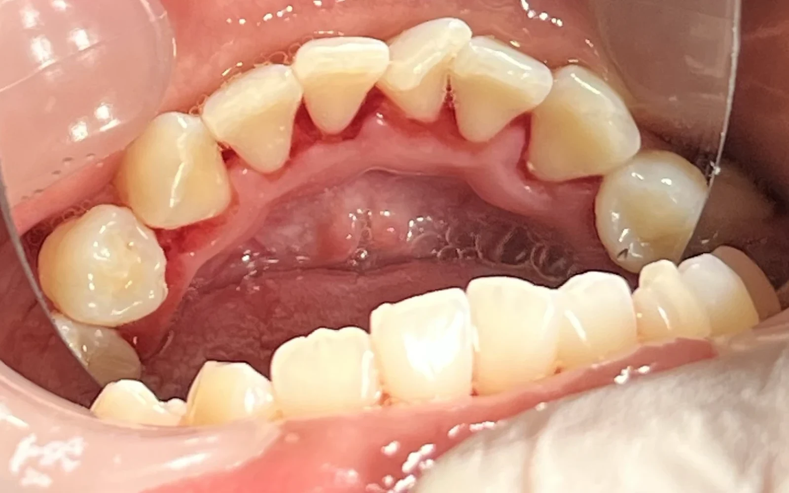 Foto layanan Scaling di DOP Dental