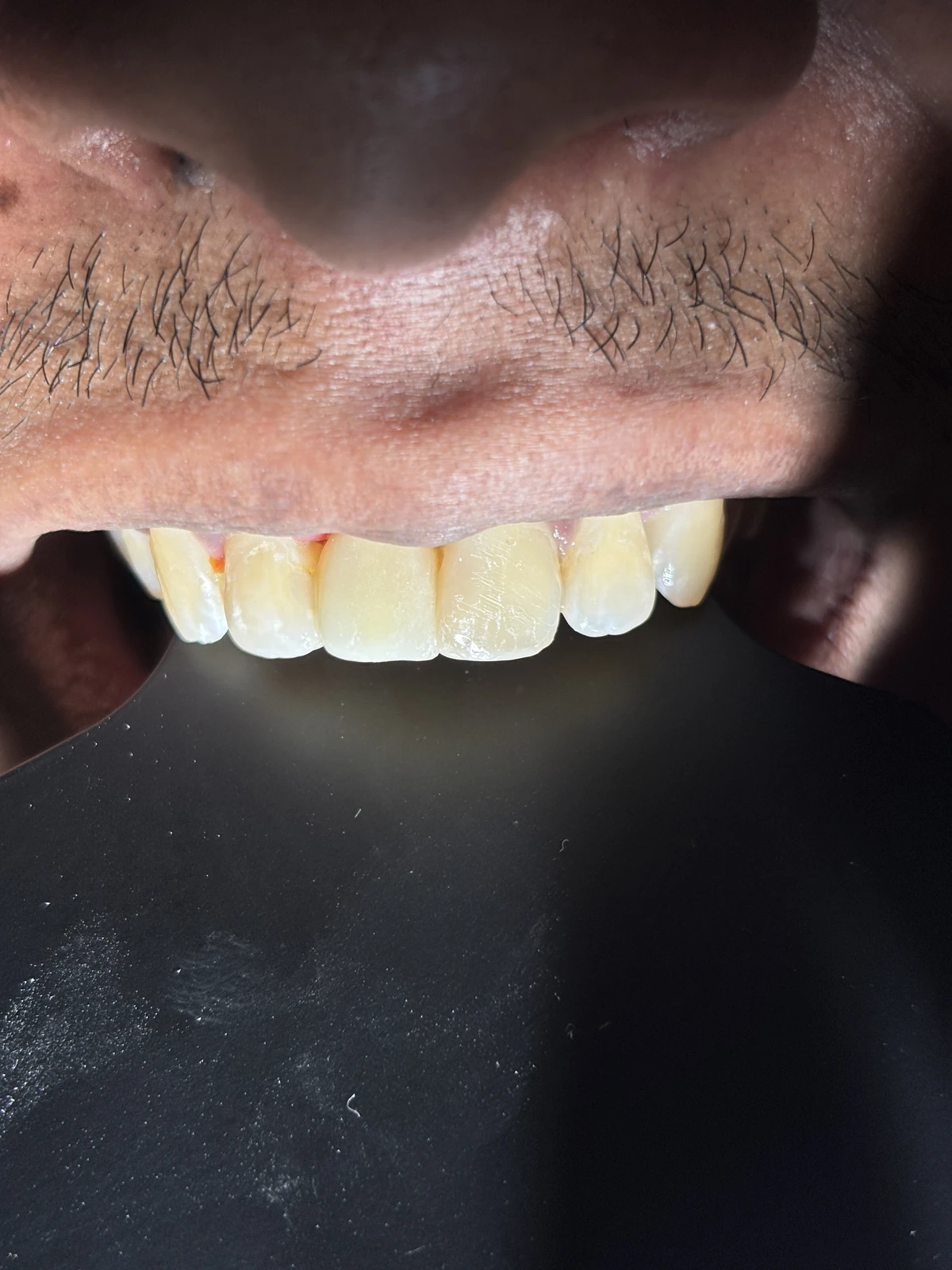 Sesudah Pemasangan Dental Crown Pelindung