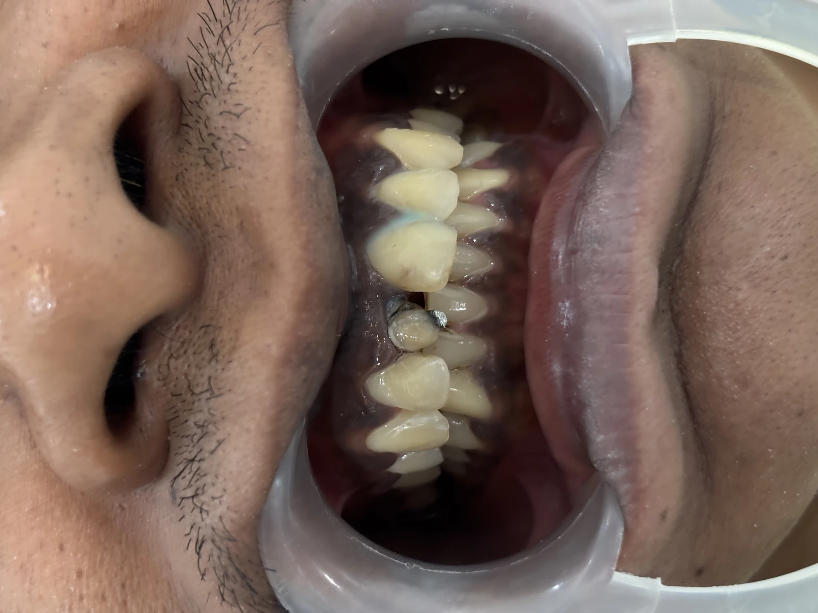 Sebelum Pemasangan Dental Crown Pelindung